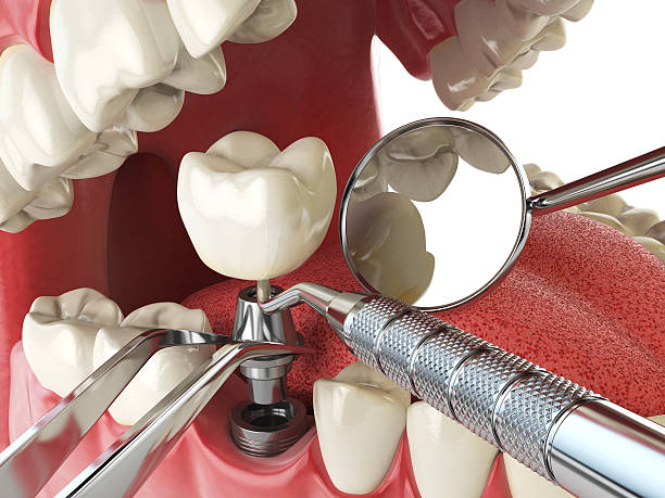 Best Emergency Root Canal Therapy in Frontenac, MO